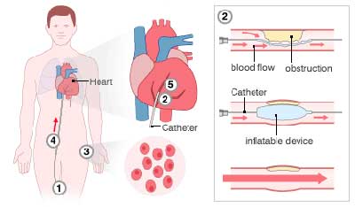 การฉีดสเต็มเซลล์เข้าสู่หัวใจ 1.ใช้เครื่องมือแพทย์แทรกเข้าไปในเส้นเลือด 2. ขยายหลอดเลือดหัวใจตีบตัน 3.แยกต้วอย่างไขสันหลังสร้างเป็นเซลล์ต้นแบบ 4.ฉีดเซลล์ต้นแบบกลับเข้าสู่หัวใจ 5.เซลล์ต้นแบบพัฒนาเป็นเซลล์กล้ามเนื้อหัวใจ (ภาพจากบีบีซี) 
