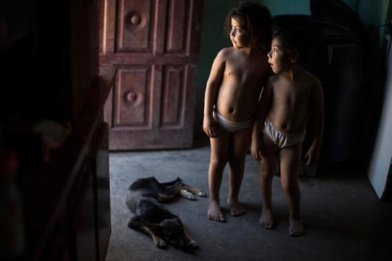 เด็กฝาแฝดชาวอาร์เจนตินาที่อาศัยในจังหวัดชาโกป่วยด้วยโรคระบบหายใจเรื้อรัง