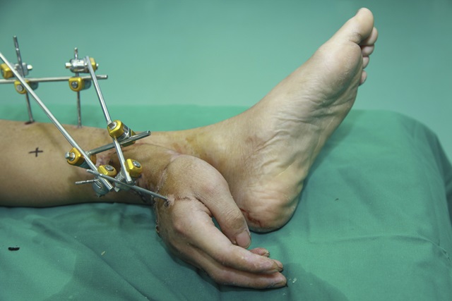 สภาพชิ้นส่วนมือขวาของนายเหว่ยที่ถูกปลูกถ่ายติดกับข้อเท้าซ้าย เพื่อฟื้นฟูความสมบูรณ์ของเซลล์อวัยวะก่อนดำเนินการผ่าตัดกลับคืนตำแหน่งเดิม (ภาพ - รอยเตอร์ส)