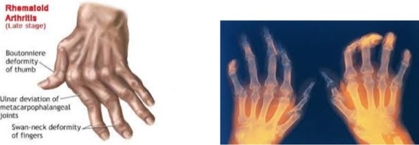  (ซ้าย) ลักษณะทางกายภาพของรูมาตอยด์ (ขวา) ลักษณะภายในของรูมาตอยด์ข้อนิ้วเมื่อถ่ายภาพด้วยรังสี 