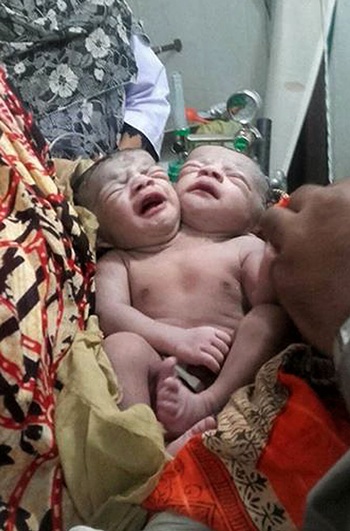 Brahmanbaria, BANGLADESH: (FILES) In this photograph taken on November 12, 2015, Bangladeshi conjoined twins receive medical care at a hospital in Brahmanbaria, some 120 kms east of Dhaka. Conjoined twin girls have died in Bangladesh less than a week after they were born, the hospital treating them said November 16. AFP PHOTO/STR/Files