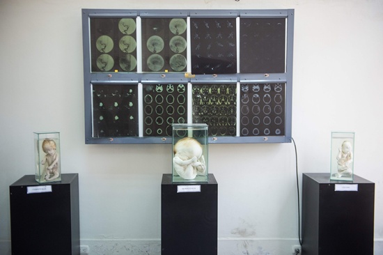 Lima: Three human fetus presenting different brain pathologies is displayed at the Museum of Neuropathology in Lima on November 16, 2016. AFP/Ernesto Benavides