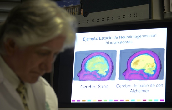 International researchers said Tuesday they have found a way to assess a persons genetic risk of developing Alzheimers disease by a given age, a tool that could lead to better diagnosis and treatment. -- Photo: AFP