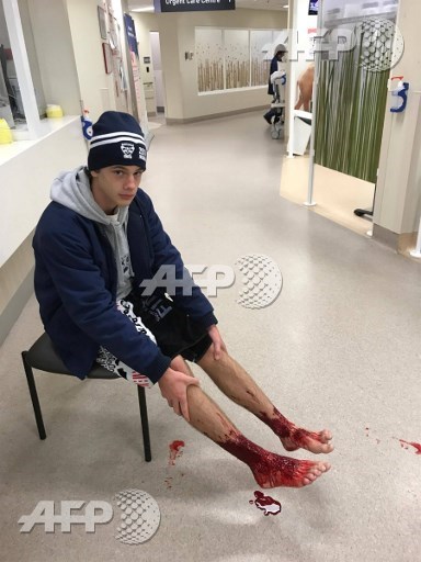 This handout picture taken and released by Jarrod Kanizay, father of Australian teenager Sam Kanizay, on August 7, 2017 shows Sam Kanizay with his injured feet waiting for medical aide at hospital in Melbourne. The Australian teenager emerged from a night-time dip in the ocean with blood streaming from his feet and ankles in a gruesome mystery that doctors have struggled to explain. Jarrod Kanizay/AFP