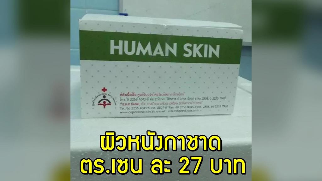 สภากาชาดไทย มีผิวหนังที่ได้รับบริจาคมา เพื่อช่วยลดอาการบาดเจ็บผู้ป่วยแผลไฟไหม้