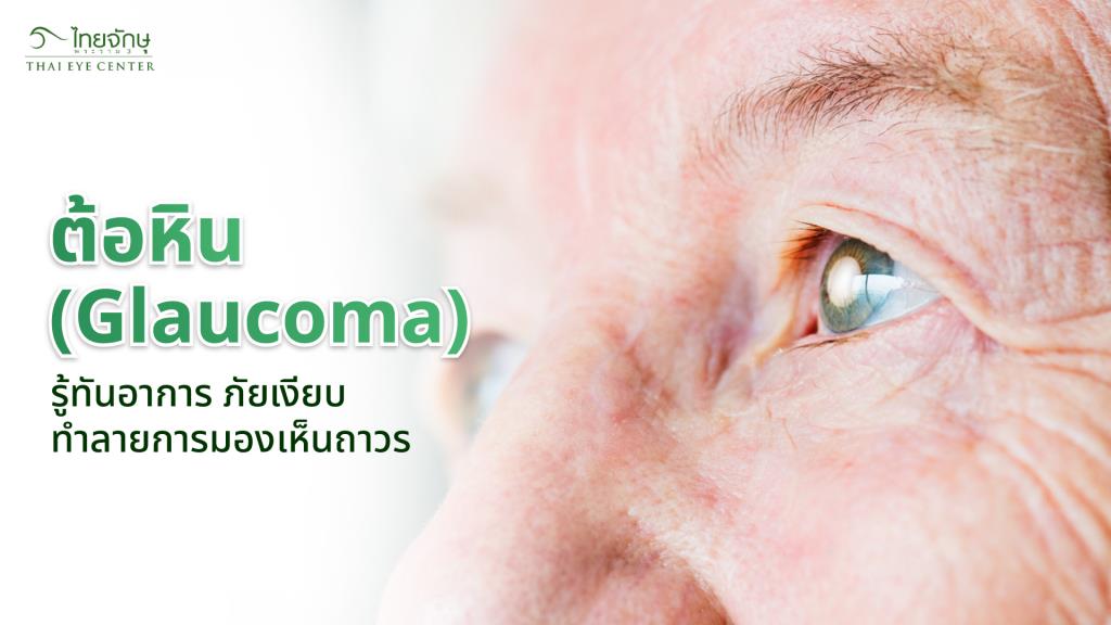 ต้อหิน (Glaucoma) รู้ทันอาการ ภัยเงียบทำลายการมองเห็นถาวร