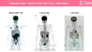 โอกาสใหม่!! จุฬาฯ โชว์นวัตกรรม "เซลล์บำบัดมะเร็ง CAR-T cell" ผู้ป่วยไทยมีหวังเข้าถึงการรักษาง่ายขึ้น