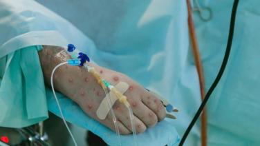 ห่วง "ฝีดาษลิง" ยังป่วยเพิ่ม เจอตายรายที่ 2 เป็นผู้ป่วยเอชไอวีขาดยา ทำอาการหนัก ติดเชื้อฉวยโอกาสแทรกซ้อน