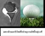 ทำอย่างไร! เมื่อข้อไหล่เคลื่อนหรือหลุด/อ.นพ.เอกวิทย์ เกยุราพันธุ์