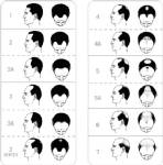 ปลูกผม  ไร้แผลเป็น/นพ.รัฐพล  ตวงทอง แพทย์ด้านผิวหนัง