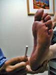 “โมโนฟิลาเมนต์” เครื่องมือเพื่อผู้ป่วยโรคเรื้อน