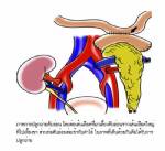 ปลูกถ่ายตับอ่อน รักษาโรคเบาหวาน