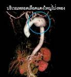 อันตราย! โรคหลอดเลือดแดงใหญ่โป่งพอง