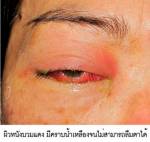 ต่อขนตาถาวร อันตราย! ใกล้ดวงตา