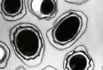 Rare anthrax case diagnosed in Minnesota