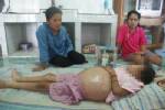 ชี้เด็กท้องโตป่วย SLE สธ.รับรักษาฟรี ชี้ไม่หายขาด