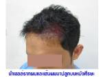 ศัลยกรรมปลูกผมถาวร