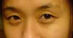 QA: ไปดูดไขมันเปลือกตา แล้วบวมตุ่ยเป็นเม็ดตะปุ่มตะปั่มเหมือนหนังคางคก เพราะอะไร?
