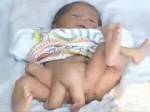 ซูฮก!! แพทย์ปากีฯผ่าตัดแยกอวัยวะส่วนเกินทารก 6 ขา สำเร็จ
