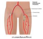 นวัตกรรมการรักษาหลอดเลือดหัวใจตีบ
