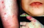 สธ.พร้อมส่งแพทย์ข้ามแดนช่วยเด็กแขมร์ป่วยมือเท้าปาก หากร้องขอ