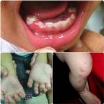 ระวัง! มือ-เท้า-ปาก และสมองอักเสบ