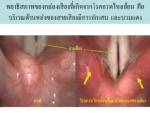 หลักให้ยา...โรคกรดไหลย้อน