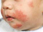 8 วิธี รักษาภูมิแพ้ผิวหนังในเด็ก / คอลัมน์ Health Line สายตรงสุขภาพ