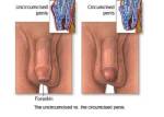 แพทย์ชี้..ขริบหนังหุ้มปลาย ช่วย “จู๋” ใหญ่ขึ้น / Health Line สายตรงสุขภาพ