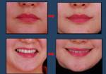 “ยิ้มถาวร” ศัลยกรรมยอดฮิตสาวเกาหลี