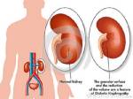 เบาหวานลงไต ปัจจัยเสี่ยงและแนวทางรักษา / “Health Line สายตรงสุขภาพ”
