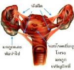 เยื่อบุโพรงมดลูกเจริญผิดที่