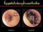 ขี้หู อุดตัน...ทำไงดี