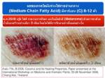 ปฏิวัติน้ำมันพืช (ตอนที่ 18): เปิดรายงาน น้ำมันมะพร้าวกับการป้องกันโรคมะเร็ง(ภาคที่ 2) !?