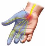 มือเท้าชาอ่อนแรง บอกโรคปลายประสาทอักเสบ เกิดแผลรักษายาก