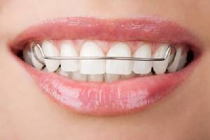 เครื่องมือคงสภาพฟัน (Retainer) สำคัญ ไฉน