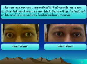 ทำไมยังไม่ยอมวิจัยเรื่อง การกดนวดตาเพื่อรักษาโรคต้อหินเรื้อรังและจอประสาทตาเสื่อม !? (ตอนที่ 5)