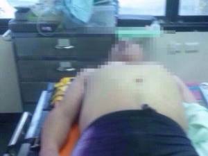นักท่องเที่ยวเล่นน้ำที่พีพีประสบเหตุสำลักน้ำดับขณะนำส่ง รพ.