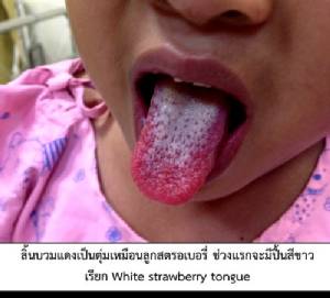 ไข้อีดำอีแดง