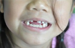 ทันตแพทย์แนะวิธีหยุดฟันเก ฟันเหยินของลูก