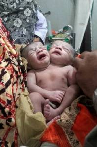 Conjoined twins die in Bangladesh