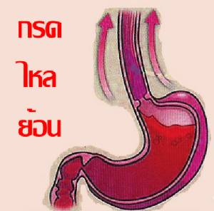 กรดไหลย้อน ภัยใกล้ตัว เรื้อรังระวังมะเร็งหลอดอาหาร