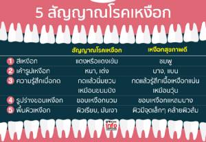รู้ทัน 5 สัญญาณโรคเหงือกก่อนสายเกินแก้