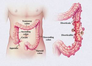 คนไทยป่วยมะเร็งลำไส้ใหญ่สูง แนะวิธีดูแลตัวเองห่างไกลโรค