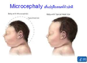 ข้อเท็จจริงปัญหา “เด็กหัวเล็ก” ทั่วโลกและไทย / ศ.เกียรติคุณ นพ.ประเสริฐ ทองเจริญ