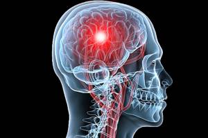 6 สัญญาณเตือนที่คุณไม่รู้เกี่ยวกับโรคเส้นเลือดในสมองแตก (Stroke)/ดร.สุพาพร เทพยสุวรรณ