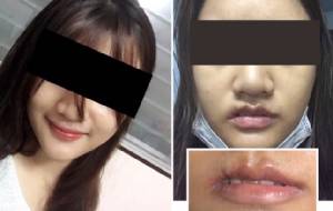 เร่งตรวจสอบ “คลินิกศัลยกรรม” ทำสาวพัทยาปากเน่า-เสียโฉม