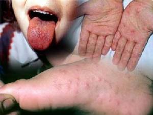 กรมควบคุมโรค ขอ ร.ร.คัดกรอง “มือ เท้า ปาก” เด็กเล็ก ชี้ระบาดง่ายช่วงหน้าฝน