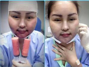 “หญิงลี” ขึ้นเตียงดูดไขมันหน้า