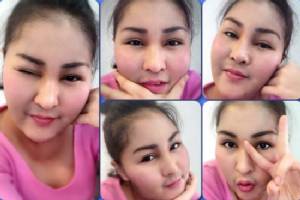 “หญิงลี” อัปเดตหน้าสด ทนอีกนิด! จะกลับมาสวยเหมือนเดิมแล้ว